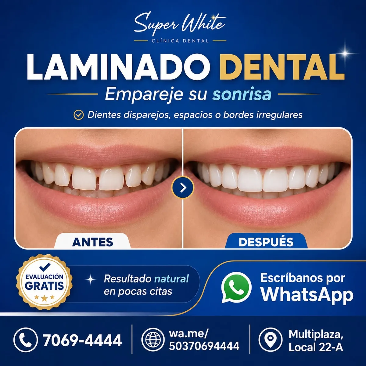 Laminado dental — antes y después